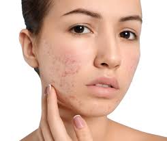 acne, acne treatment, oily skin, blemishes, DIY face masks